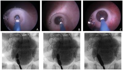 Long-Term Outcomes in Primary Obstructive Megaureter Treated by Endoscopic Balloon Dilation. Experience After 100 Cases